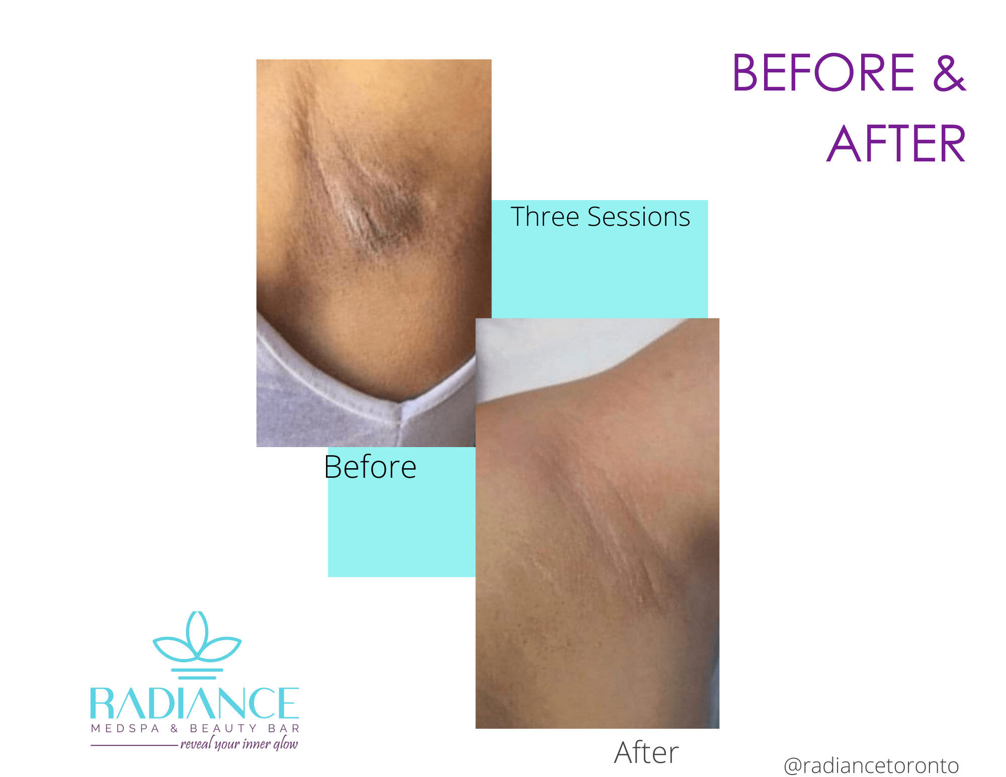 Intimate Lightening Underarm before and after