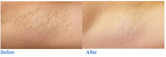 Armpit Laser Hair Removal Before and After