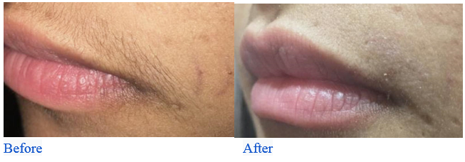 Upper Lip Laser Hair Removal Before and After